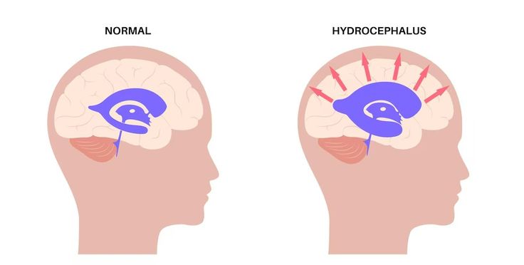 Hydrocephalus and the NDIS - Beyond