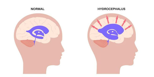 Hydrocephalus and the NDIS - Beyond