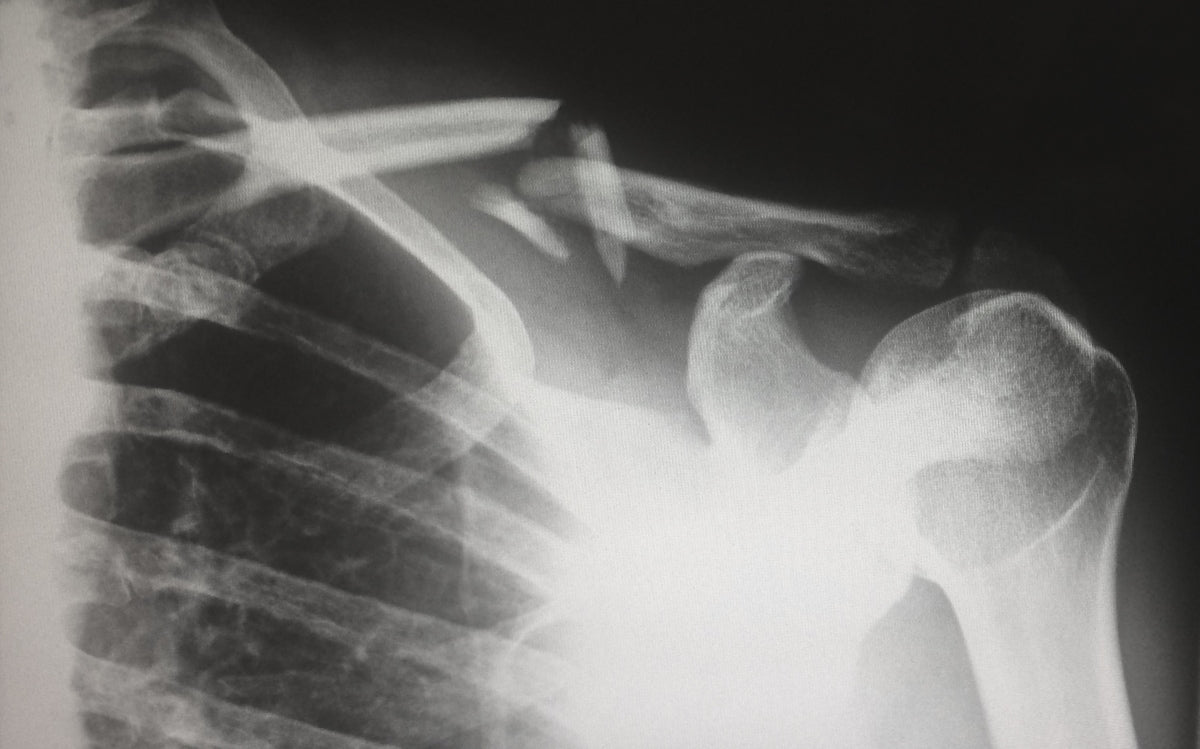 Osteogenesis Imperfecta and the NDIS - Beyond