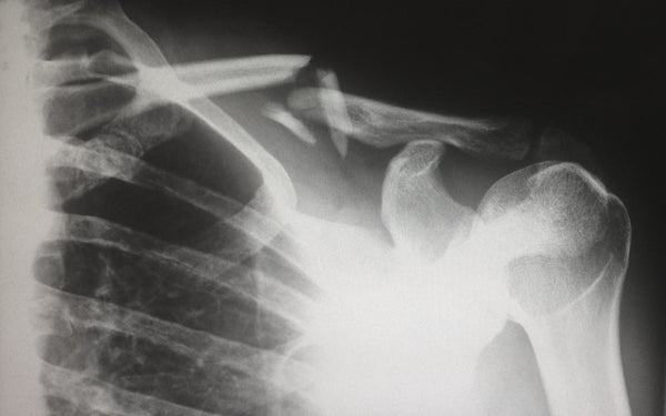 Osteogenesis Imperfecta and the NDIS - Beyond